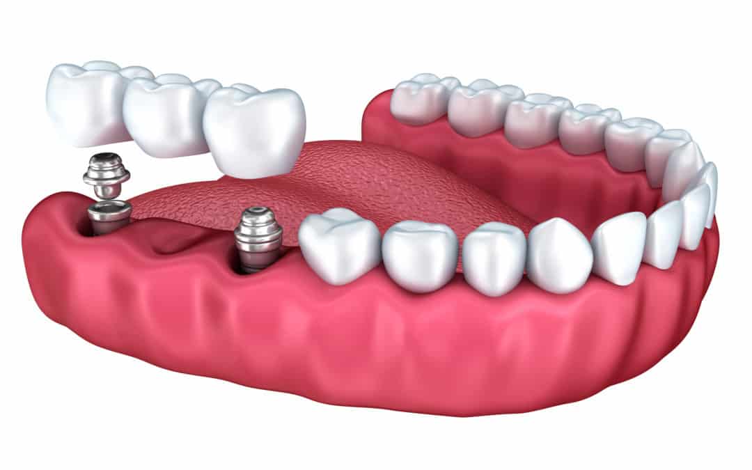 La rivoluzione dell’implantologia senza bisturi! (Flap Less)