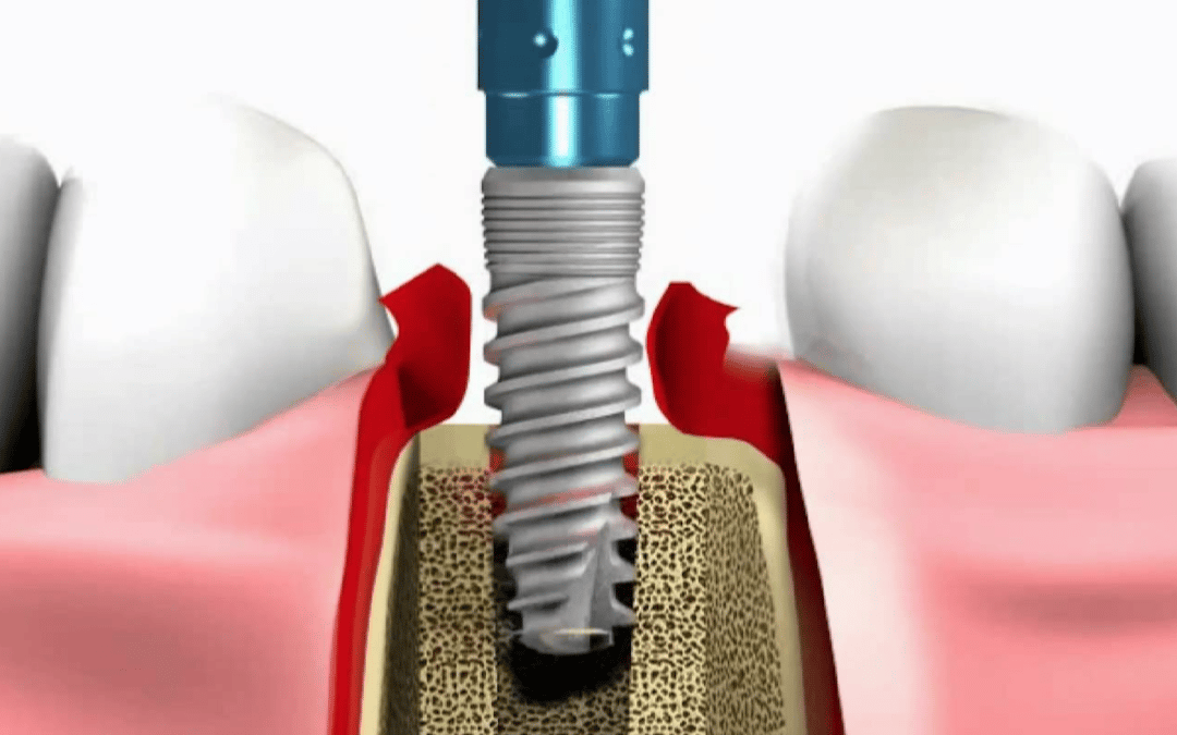 tre segreti implantologia