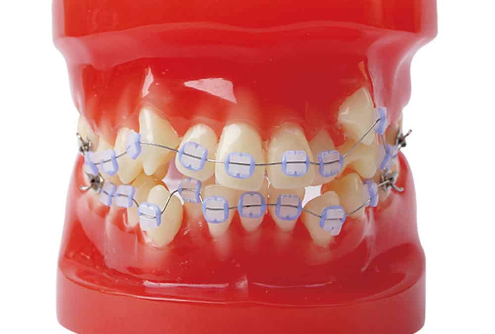 Conosci gli esami indispensabili prima di mettere l’apparecchio per i denti?