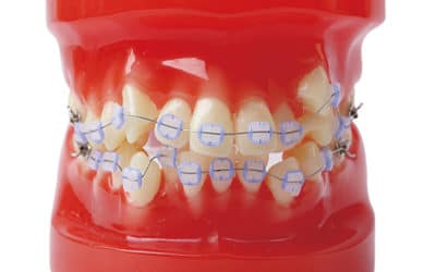 Conosci gli esami indispensabili prima di mettere l’apparecchio per i denti?