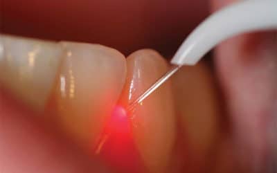 Perchè curarsi con il laser? Scopri la cura innovativa per la Parodontite