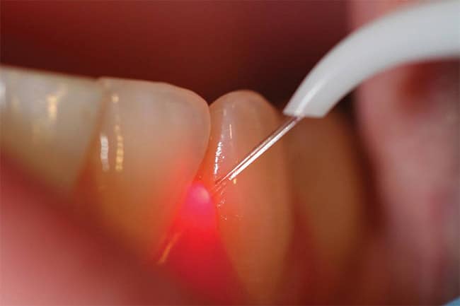 Perchè curarsi con il laser? Scopri la cura innovativa per la Parodontite