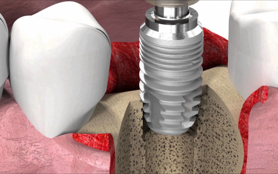 È possibile avere denti fissi in una sola seduta?