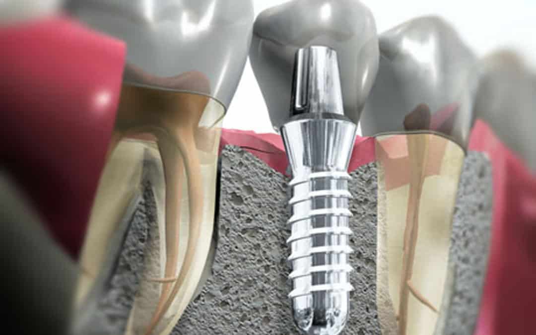 Impianto dentale post estrattivo: cos’è e quali sono i vantaggi