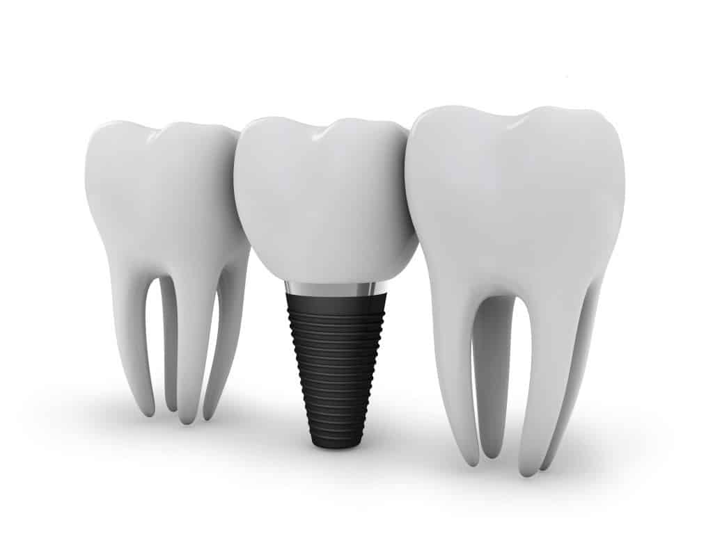 Immagine di 3 denti, uno dei 3 è un impianto dentale identificabile dalla vite