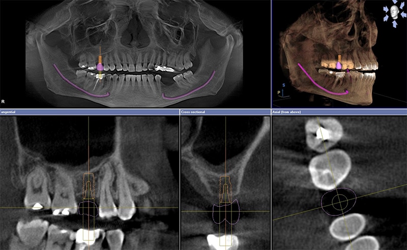 Scopri la Tac Cone Beam 3D dentale!