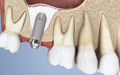 Ho dolore a un impianto dentale, qual è la causa?