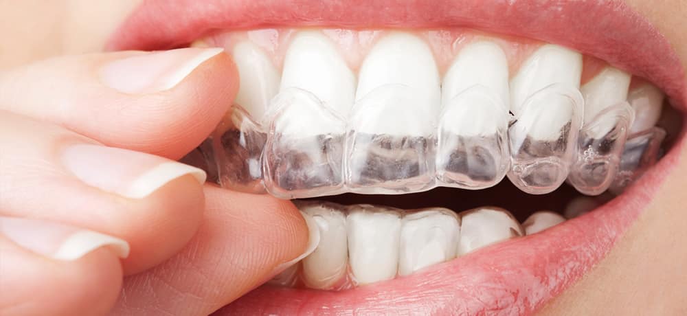 Denti: apparecchio invisibile. Per cosa si usa, benefici e consigli