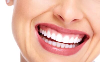 Tecniche di sbiancamento dentale