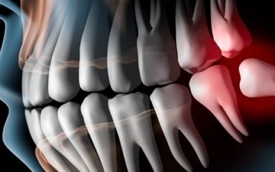 Denti del giudizio: quando e perché rimuoverli