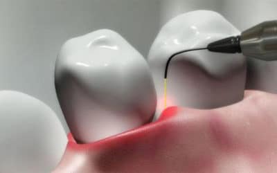 Come curare la parodontite col laser senza bisturi e senza dolore