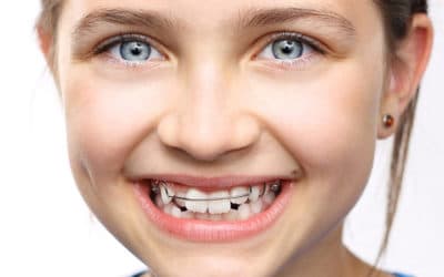 Apparecchio per i denti: sai qual è quello giusto per il tuo bambino? qual è l’età giusta per iniziare?