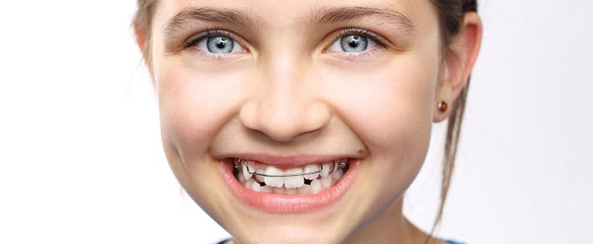 Apparecchio per i denti: sai qual è quello giusto per il tuo bambino? qual è l’età giusta per iniziare?