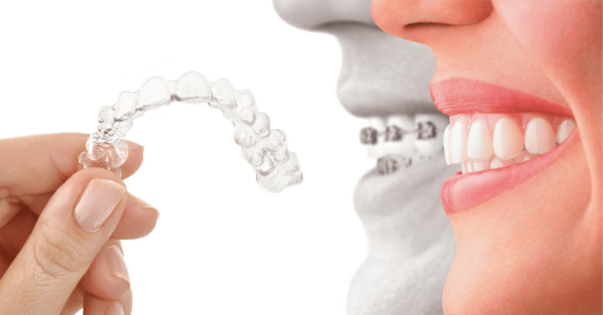 signora che sorride alzandosi il labbro con il dito per far vedere le gengive arrossate - dentista rovereto dott maini