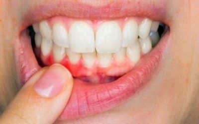 Denti sani… ma alle gengive ci pensi?