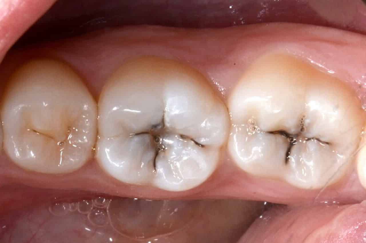 Fa Male Togliere Una Carie Senza Anestesia Fa Male Togliere Una Carie Senza Anestesia