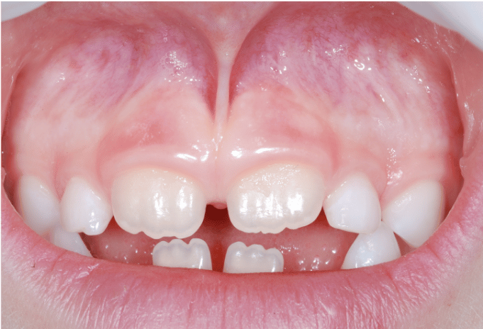 Laser dentale: perché è utile per togliere il frenulo