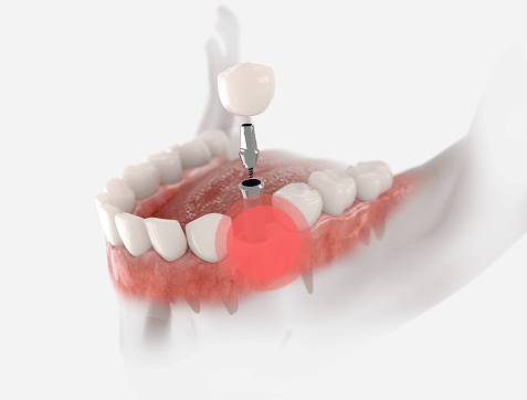 Impianto dentale dolorante