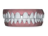 Denti con spaziatura eccessiva