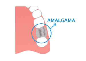 Amalgama di mercurio, amalgama dentale