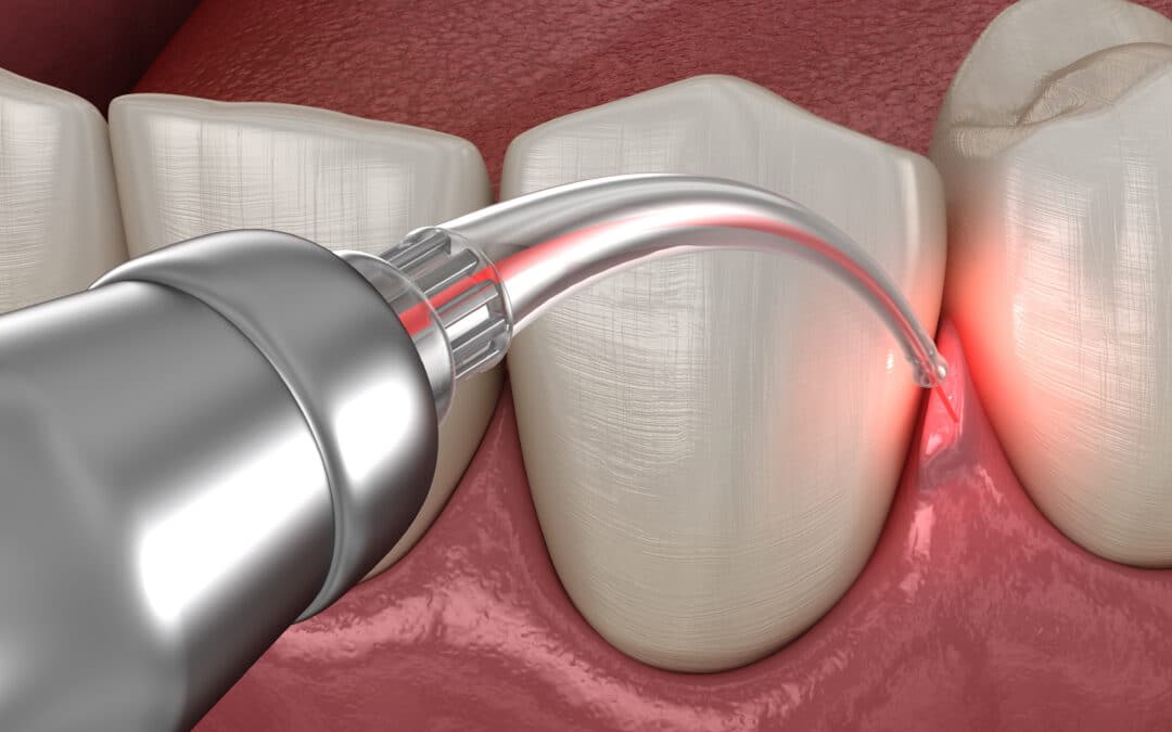 Intervento di correzione gengivale con laser. Dettaglio del laser che cura la gengiva infiammata