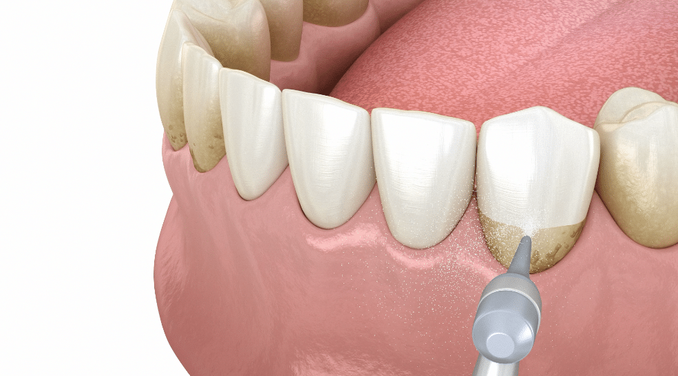 pulizia dentale - igiene dentale innovativo