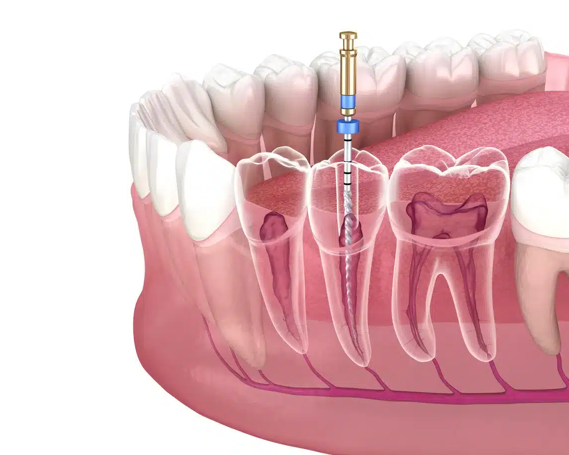Endodonzia Dott Maini Rovereto Dentista rovereto maini